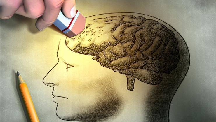 آلزایمر